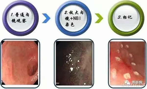 優(yōu)勢(shì)技術(shù) | 內(nèi)鏡粘膜下剝離術(shù)（ESD）消化道病變的超級(jí)微創(chuàng)手術(shù)